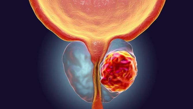 Prevención, clave contra el cáncer de próstata